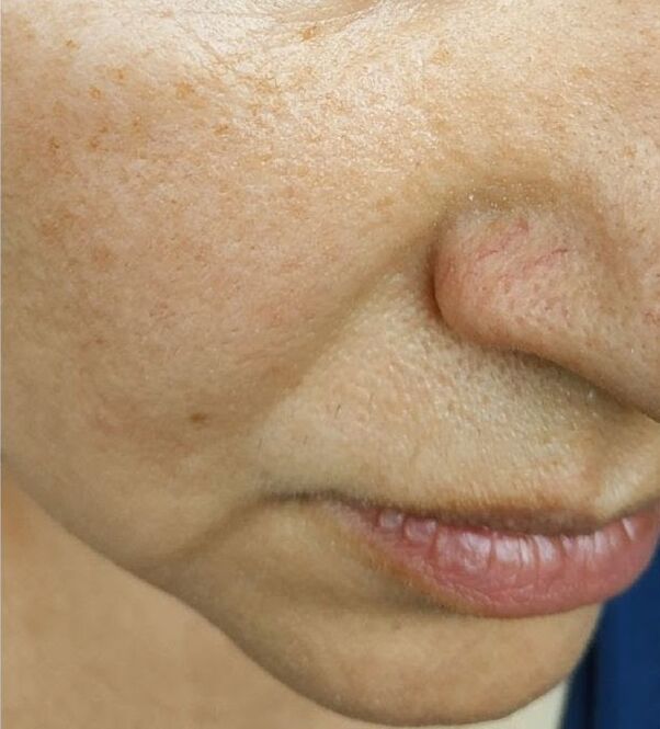 Until the age of 40, the Nasolabial folds appeared