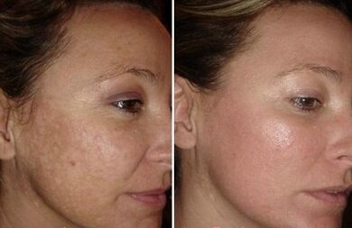 Renewal of the laser facial skin before and after photos