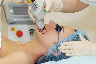 Types of Laser Facial Renewal
